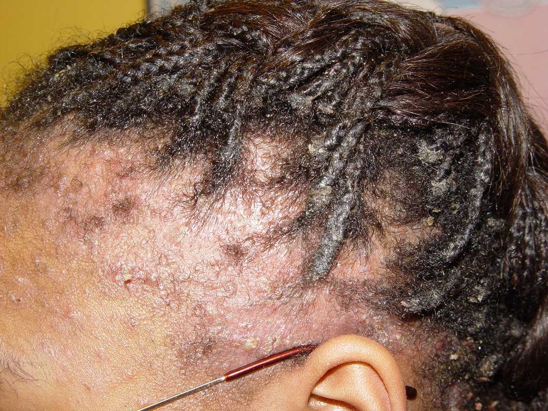 alopecia traumatica - Terapia Capilar e sua importância para a saúde dos fios