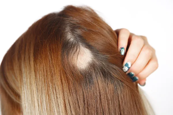 alopecia - Terapia Capilar e sua importância para a saúde dos fios